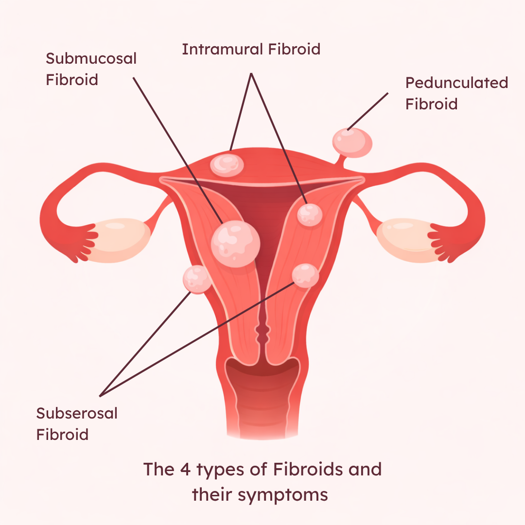 What are Fibroids